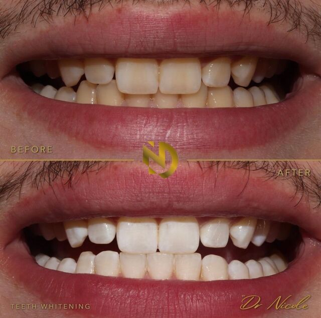 Get ready for summer with BESPOKE home whitening ✨🦷

Book your consultation and let’s brighten your smile together with our at home and in surgery teeth whitening 🦷

DM to book in 📲

#teethwhitening #toothwhitening #professionalwhitening #whitening #brightsmile #smile