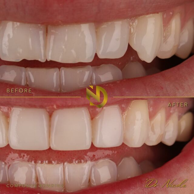 Symmetry APPRECIATION 😍🦷

Small edge bonding and tooth whitening can make such a difference to not only your smile, but your confidence 🥰

LAST CHANCE to book a consultation this Sunday at @hollyhousedentalpractice and secure 10% off your smile makeover — ONE SPACE REMAINING 🦷🦷🦷

DM to book ❤️

#smilemakeover #consultation #compositebonding #veneers #compositeveneers #teethwhitening #smile #makeover #teeth