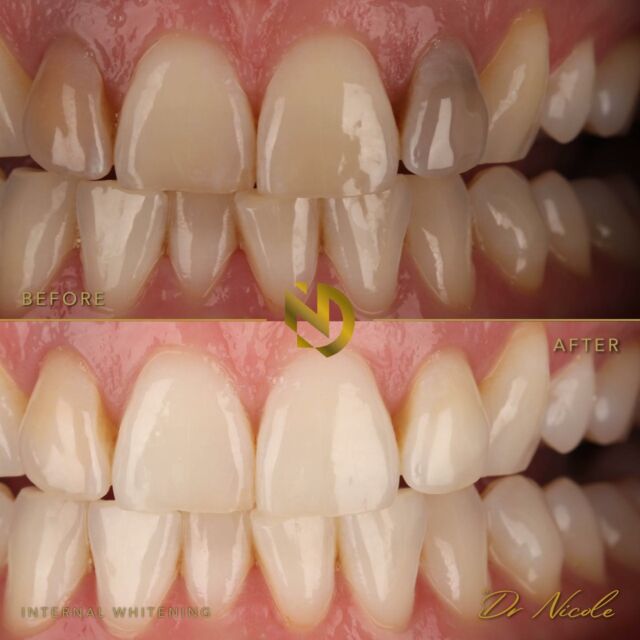 Did you know we can fix darkened teeth? 😱🦷

We did a course of internal whitening for my patient to brighten the darkened teeth that have darkened over time! 

Want more information on internal tooth whitening? DM me and we can discuss more! 

#internalwhitening #teethwhitening #professionalwhitening #cosmeticdentistry #cosmeticdentist