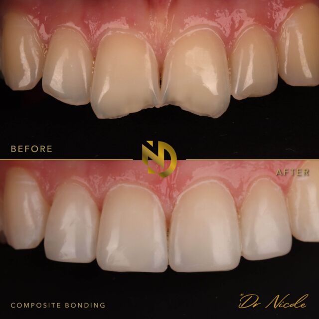 Did you know this only took less than 2 hours 😱🤯❤️

A whole new smile in a matter of hours 🤯🦷

Want to find out how we can transform your smile? DM me “consult” and let’s have a chat 💬 

#smilemakeover #compositebonding #veneers #composite #edgebonding #manchesterdentist #cosmeticdentist