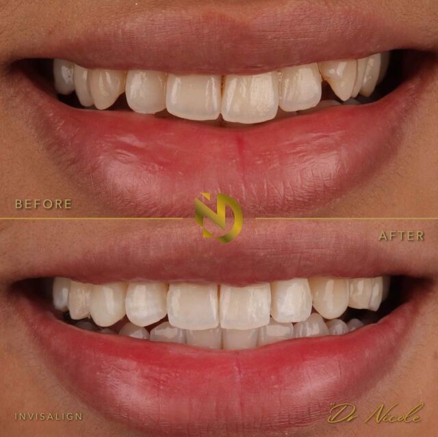 Perfection in alignment✨🦷 

My patient simply wanted to perfect the alignment of her teeth to give her the perfect symmetrical smile. We did a short course of Invisalign to give her the dream results ❤️

The most effective way for a naturally perfect smile 🤩

DM for more information! 

#smilemakeover #invisalign #veneers #straightteeth #edgebonding #manchesterdentist #cosmetic-dentist #clearbraces