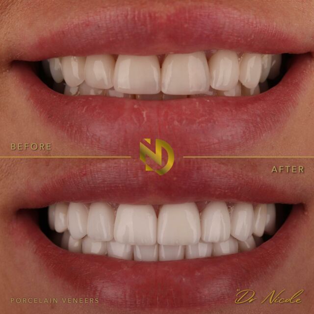 10% OFF SMILE MAKEOVERS 🤯💥🦷 only on consultations booked on Sunday 19th May ⬇️

DM me and we can book you in 🫶🏼

This was a smile upgrade with porcelain veneers bespoke to her smile on her upper teeth and composite veneers on her lower teeth ✨

Want to discuss more about veneer options? DM me and let’s chat 💬 

#porcelainveneers #veneers #veneer #makeover #smilemakeover #cosmeticdentist